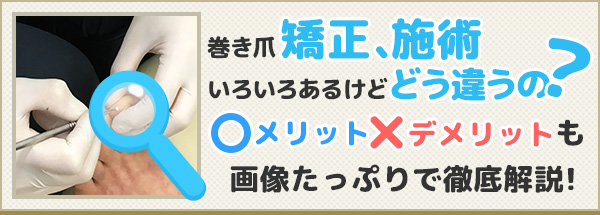 巻き爪矯正、施術、いろいろあるけど、どう違うの？