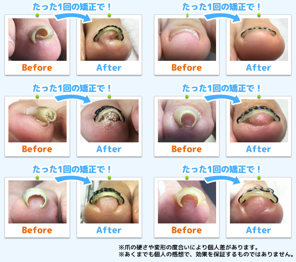 圧倒的な矯正力。たった1回の施術例です!!